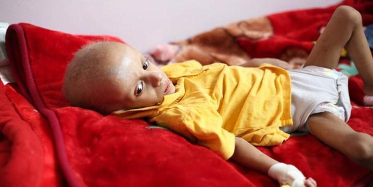 وزارت بهداشت یمن: هر 10 دقیقه یک کودک یمنی به دلیل سوء تغذیه می میرد
