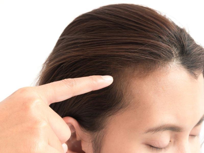 عوامل ریزش مو در زنان عوامل ریزش مو در زنان