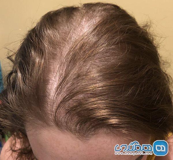 چرا خانم ها دچار ریزش مو می شوند؟