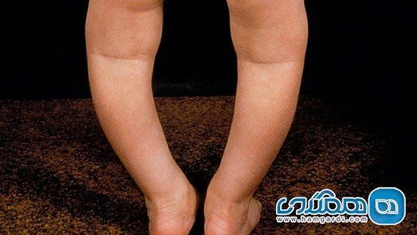 همه چیز درباره زانوهای پرانتزی در بچه ها همه چیز درباره زانوهای پرانتزی در بچه ها