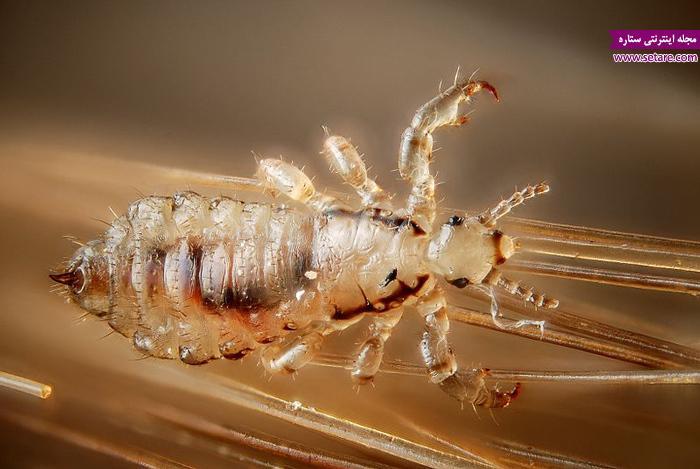 راه های درمان شپش سر چیست؟