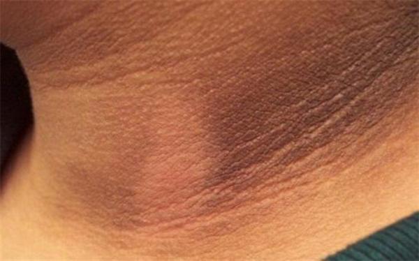 علایم هشداردهنده تغییر رنگ پوست گردن