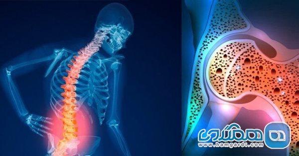 پوکی استخوان مختص سنین سالمندی نیست