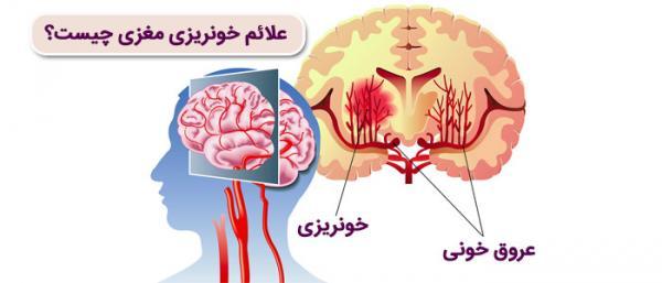 علائم خونریزی مغزی چیست؟