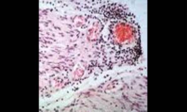 نشانگان گیلن باره