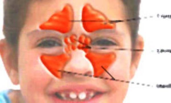 سینوزیت در بچه ها