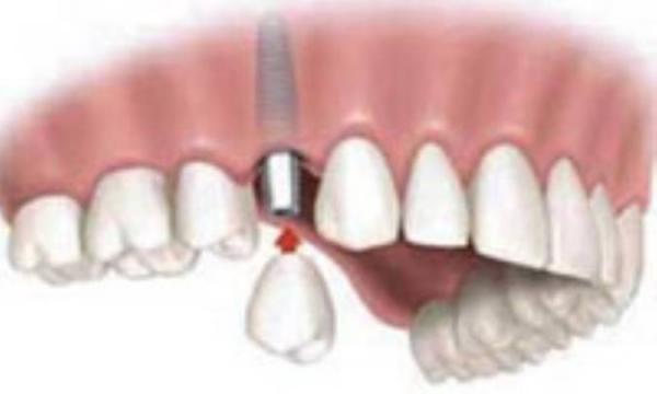 جرم دندان، از پیشگیری تا درمان