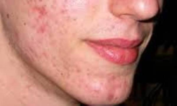 کربوهیدرات ها و آکنه کربوهیدرات ها و آکنه